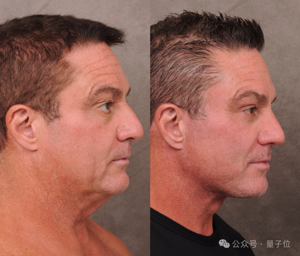 硅谷祛眼袋,海淀求嫩肤:中外科技老哥都在偷偷卷颜值 硅谷祛眼袋,海淀求嫩肤:中外科技老哥都在偷偷卷颜值